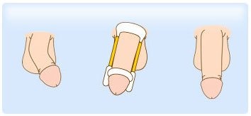 lapeyronie-traitement